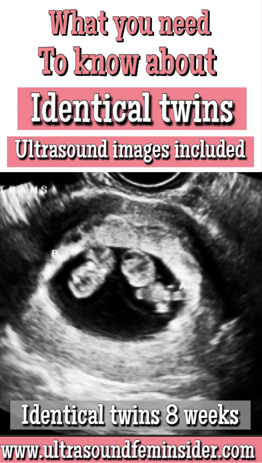 Everything you need to know about Identical Twins. Ultrasound included.