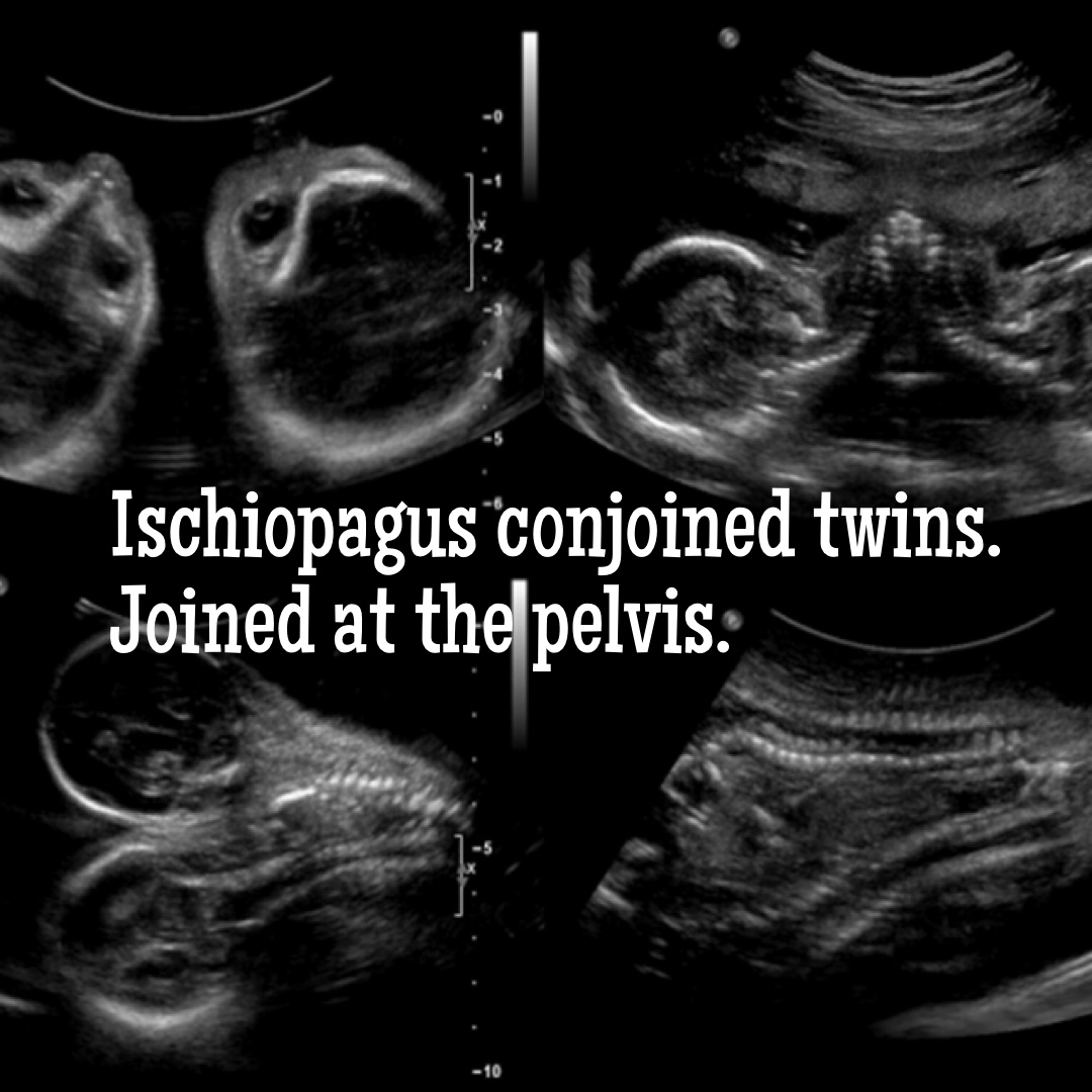 Facts about conjoined twins everyone should know about.