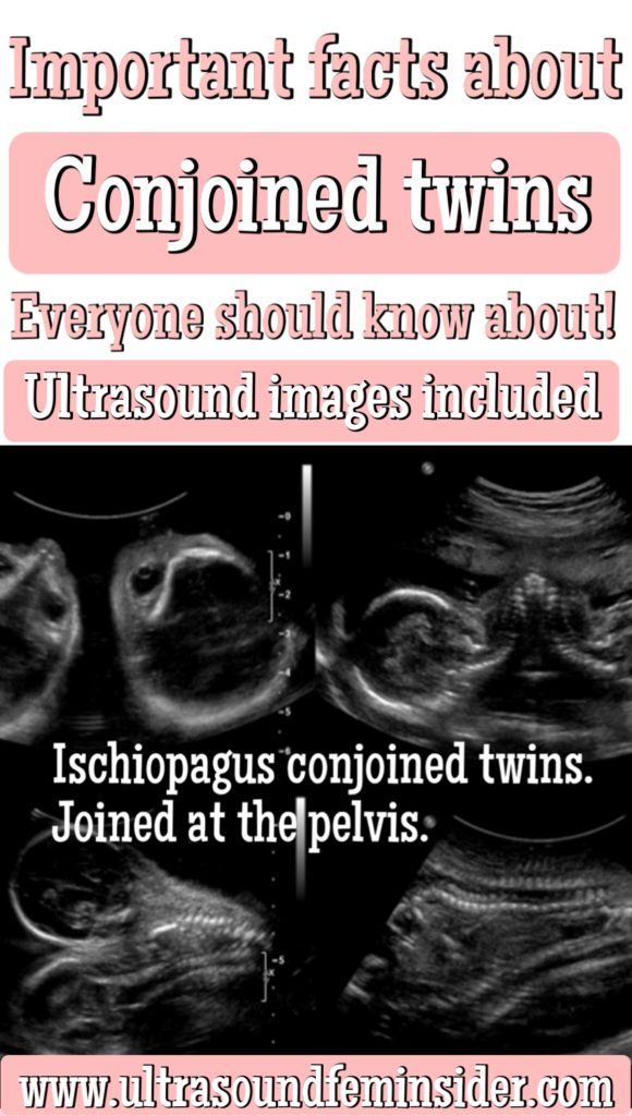 Facts about conjoined twins everyone should know about.