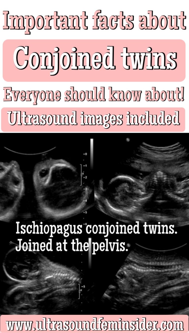 Facts About Conjoined Twins Everyone Should Know Ultrasoundfeminsider 5830