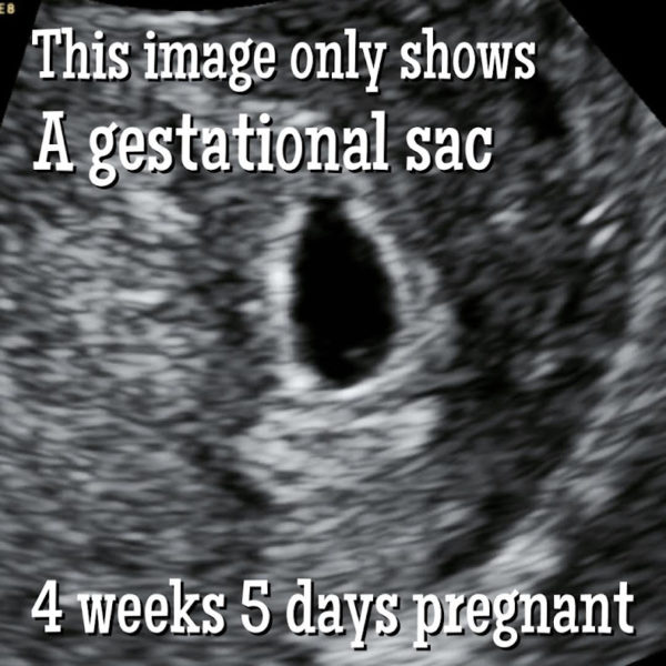 First Trimester Baby Development by Week. - Ultrasoundfeminsider