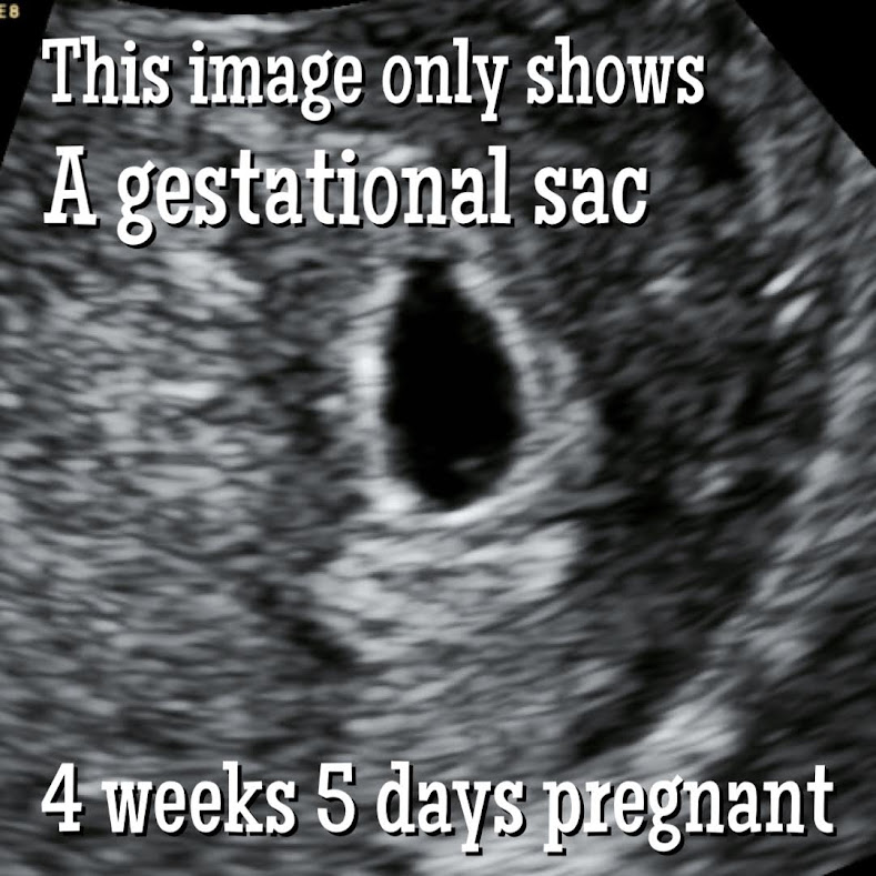 4 weeks baby ultrasound