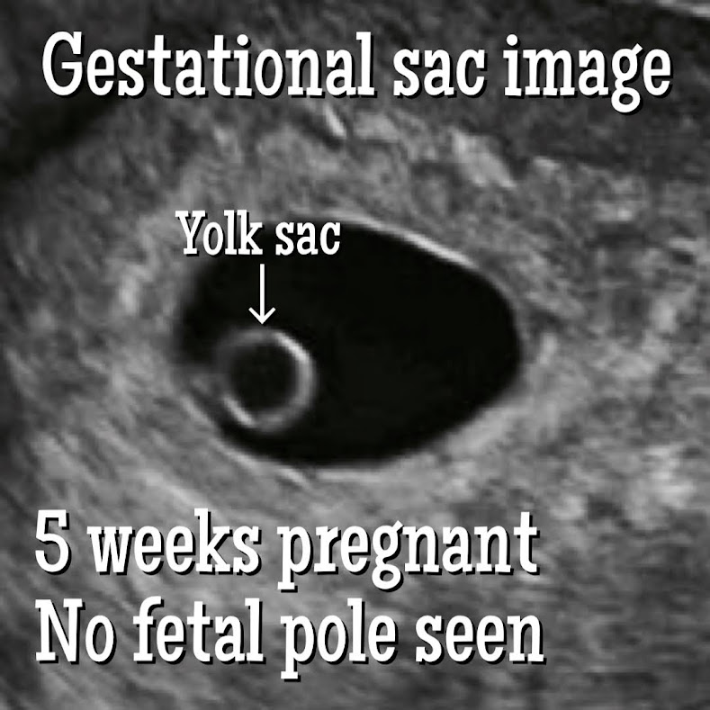 5 weeks baby ultrasound