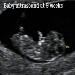 baby ultrasound at 9 weeks