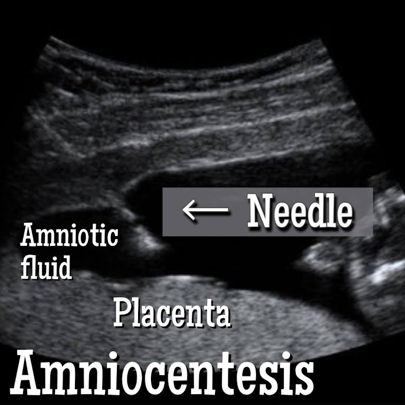 Advantages and Disadvantages of Amniocentesis.