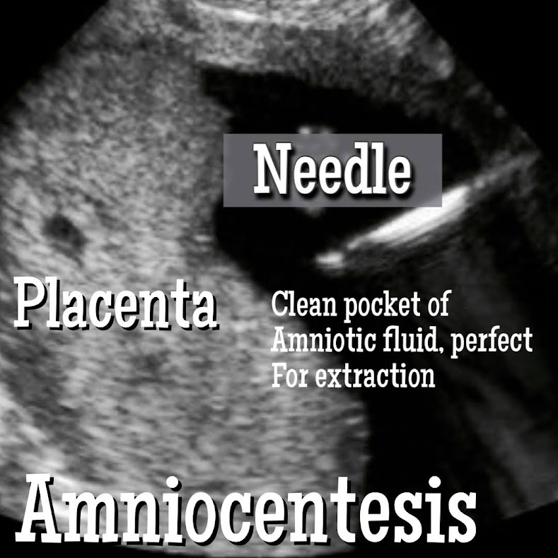 Advantages and Disadvantages of Amniocentesis.