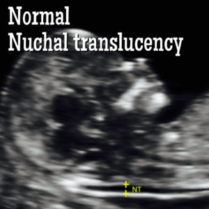 Nuchal Translucency. What does a Thickened Nuchal Translucency Mean ...