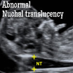 Nuchal Translucency. What does a Thickened Nuchal Translucency Mean ...