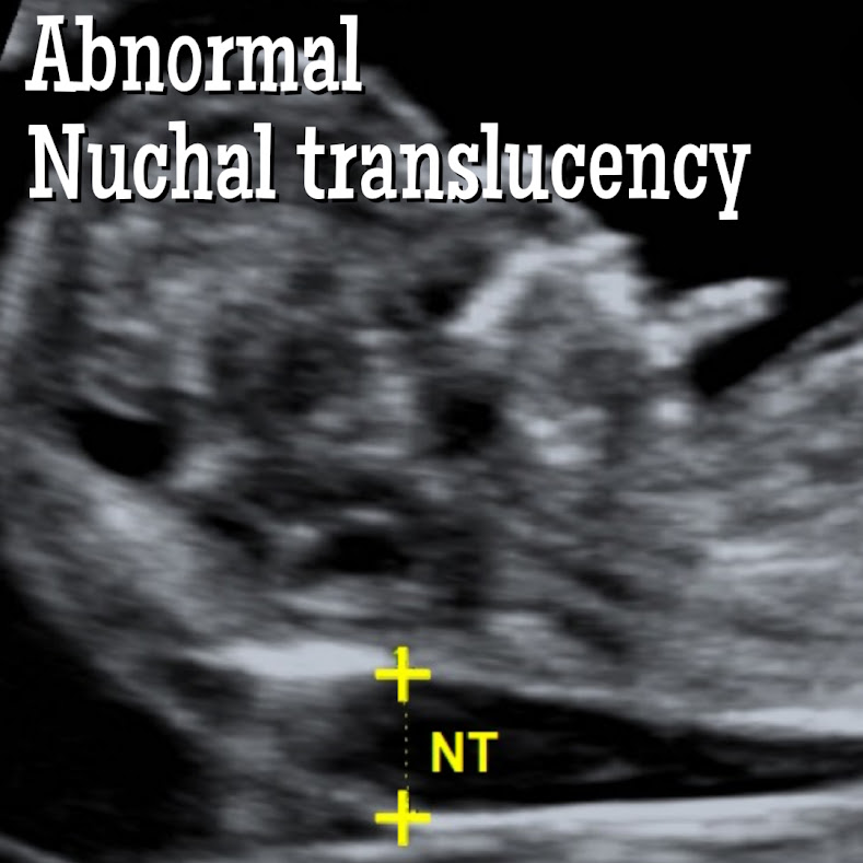 Nuchal Translucency. What does a Thickened Nuchal Translucency Mean?