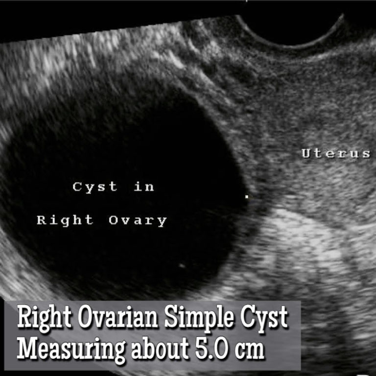 Ovarian Follicle vs an Ovarian Cyst? How to Tell the Difference ...