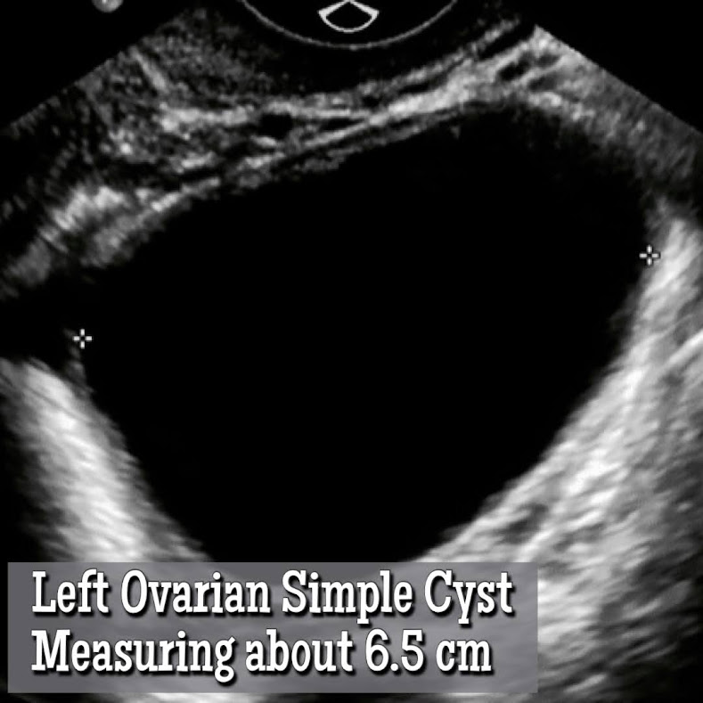 Ovarian Follicle vs an Ovarian Cyst? How to Tell the Difference. Ultrasound image of an Ovarian cyst.