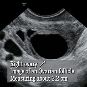 Ovarian Follicle vs an Ovarian Cyst? How to Tell the Difference ...