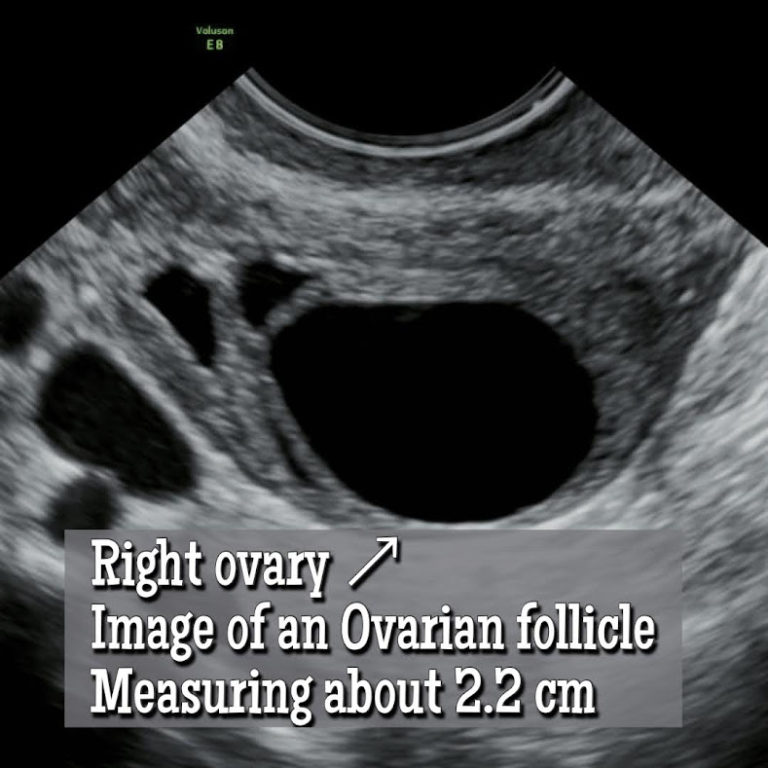 Ovarian Follicle Vs An Ovarian Cyst How To Tell The Difference