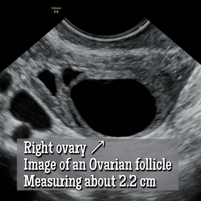 Ovarian Follicle vs an Ovarian Cyst? How to Tell the Difference. Ultrasound image of an Ovarian follicle.