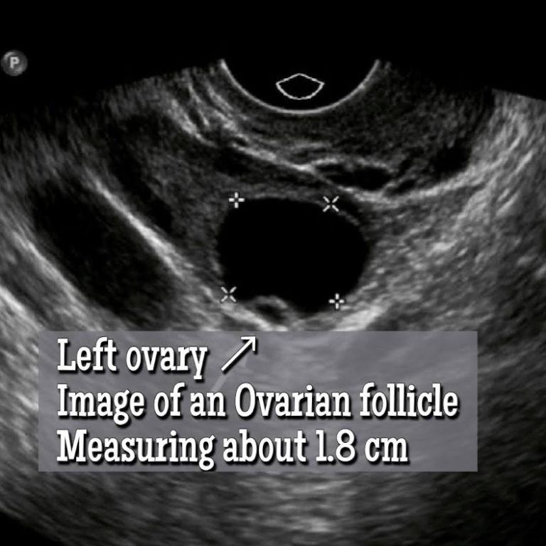 Ovarian Follicle vs an Ovarian Cyst? How to Tell the Difference ...