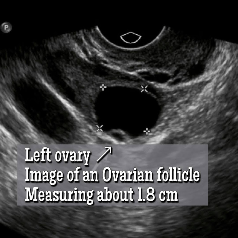 Ovarian Follicle vs an Ovarian Cyst? How to Tell the Difference. ultrasound image of an Ovarian Follicle.