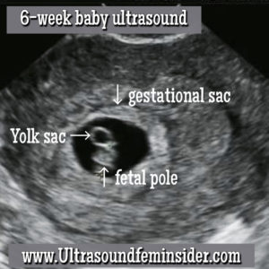 Can a 6 Weeks Pregnancy Be Detected in Ultrasound? Here is What You ...