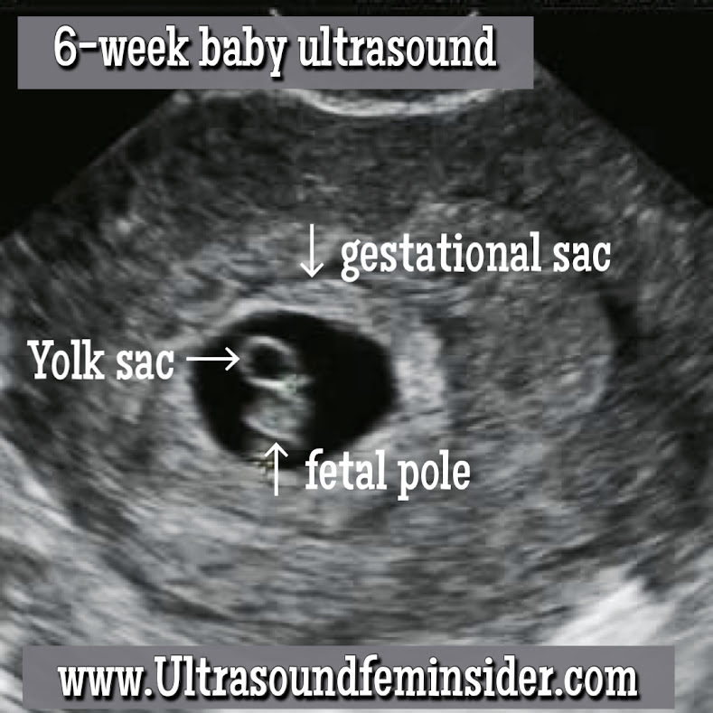 Can 6 Weeks Pregnancy Be Detected in Ultrasound?