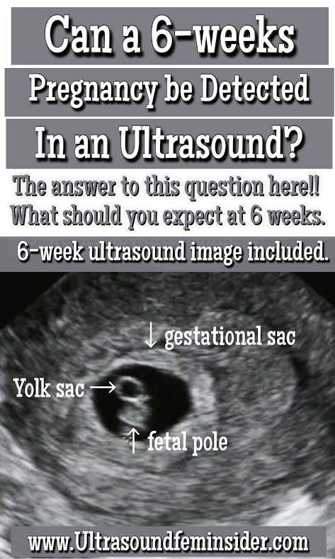 Can 6 Weeks Pregnancy Be Detected in Ultrasound? Here is What You Need to Know.