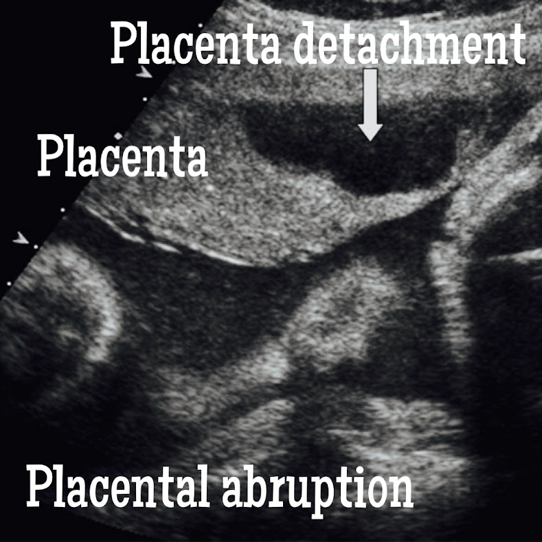 Causes of placental abruption. Ultrasound image about Placental abruption.