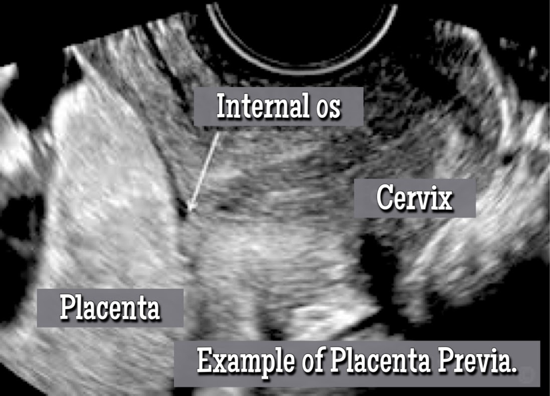 How does placenta previa affects pregnancy?