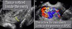 Retained Products of Conception (RPOC). What is it and Risks ...